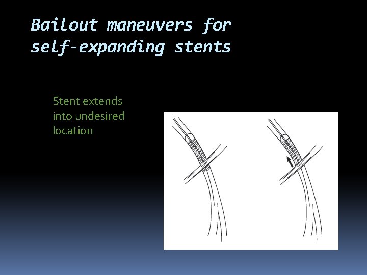 Bailout maneuvers for self-expanding stents Stent extends into undesired location 