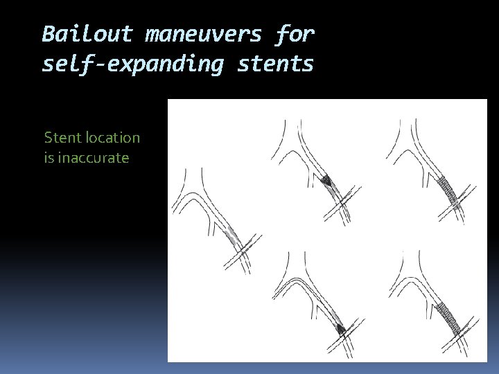Bailout maneuvers for self-expanding stents Stent location is inaccurate 