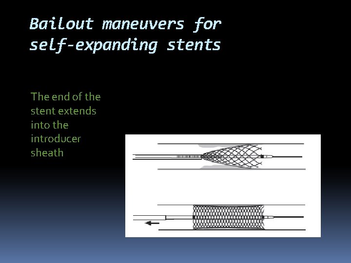 Bailout maneuvers for self-expanding stents The end of the stent extends into the introducer