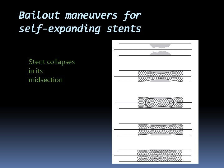 Bailout maneuvers for self-expanding stents Stent collapses in its midsection 