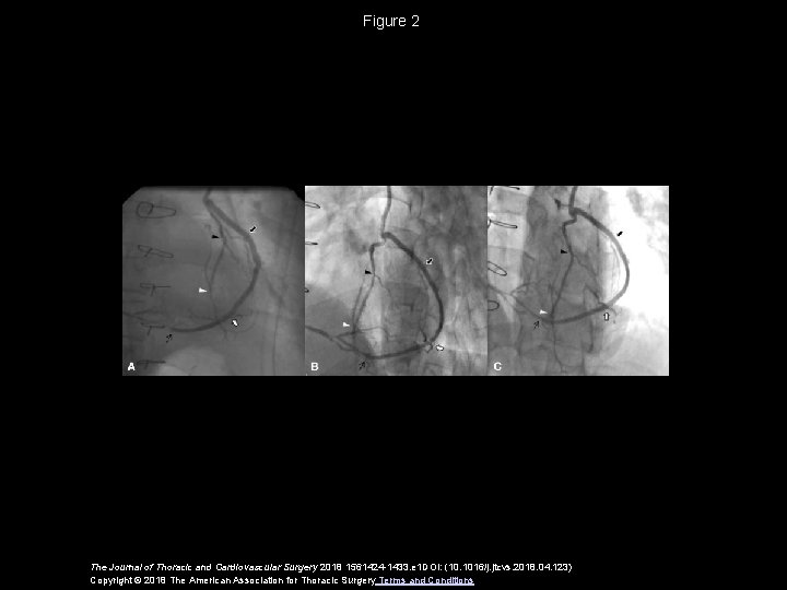 Figure 2 The Journal of Thoracic and Cardiovascular Surgery 2018 1561424 -1433. e 1