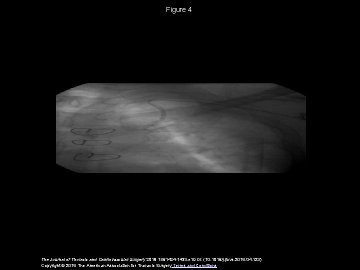 Figure 4 The Journal of Thoracic and Cardiovascular Surgery 2018 1561424 -1433. e 1