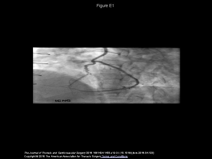 Figure E 1 The Journal of Thoracic and Cardiovascular Surgery 2018 1561424 -1433. e
