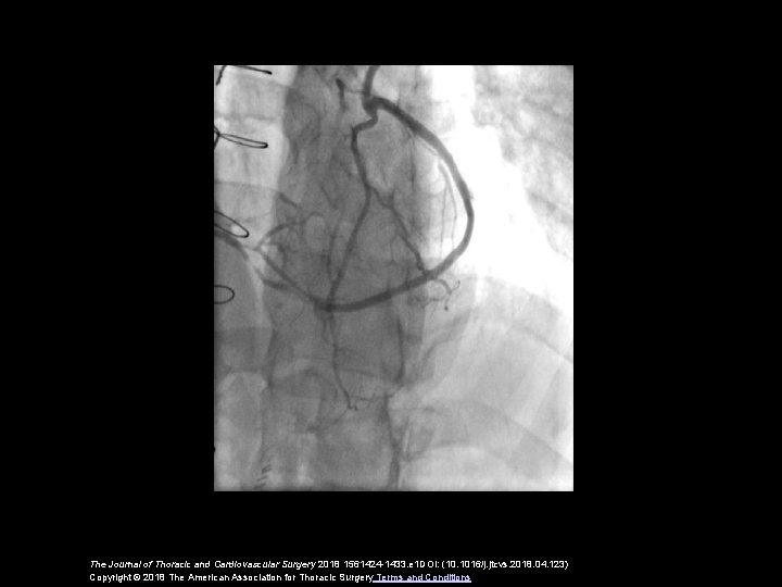 The Journal of Thoracic and Cardiovascular Surgery 2018 1561424 -1433. e 1 DOI: (10.