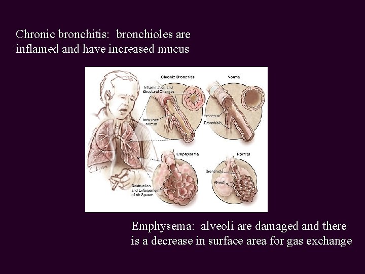 Chronic bronchitis: bronchioles are inflamed and have increased mucus Emphysema: alveoli are damaged and
