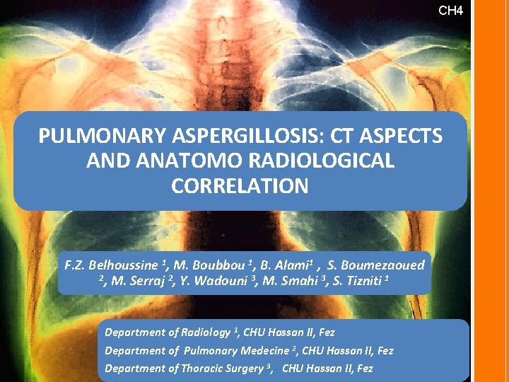 CH 4 PULMONARY ASPERGILLOSIS: CT ASPECTS AND ANATOMO RADIOLOGICAL CORRELATION F. Z. Belhoussine 1,