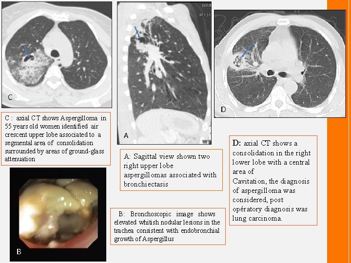 C D C : axial CT shows Aspergilloma in 55 years old women identified