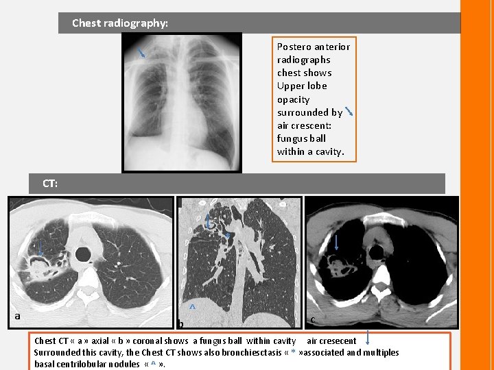  Chest radiography: Postero anterior radiographs chest shows Upper lobe opacity surrounded by air
