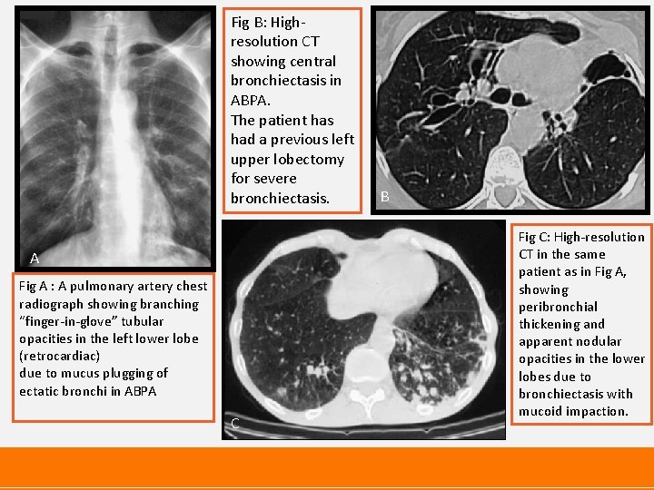 Fig B: Highresolution CT showing central bronchiectasis in ABPA. The patient has had a