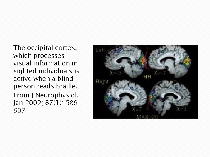The occipital cortex, which processes visual information in sighted individuals is active when a The occipital cortex, which processes visual information in sighted individuals is active when a
