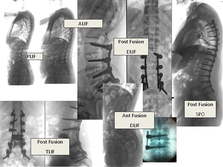 ALIF Post Fusion DLIF Post Fusion Ant Fusion DLIF Post Fusion TLIF SPO 