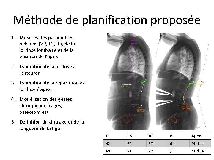 Méthode de planification proposée 1. Mesures des paramètres pelviens (VP, PS, IP), de la