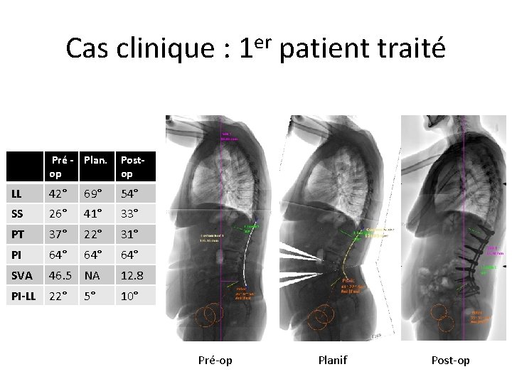 Cas clinique : 1 er patient traité Pré - Plan. op Postop LL 42°