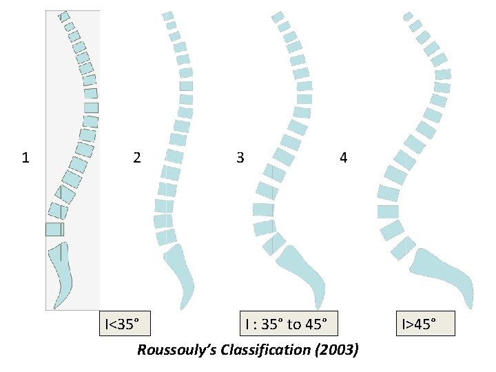 1 2 I<35° 3 4 I : 35° to 45° Roussouly’s Classification (2003) I>45°