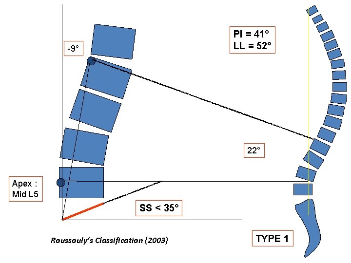 PI = 41° LL = 52° -9° 22° Apex : Mid L 5 SS
