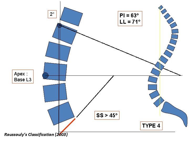 2° PI = 63° LL = 71° Apex : Base L 3 SS >