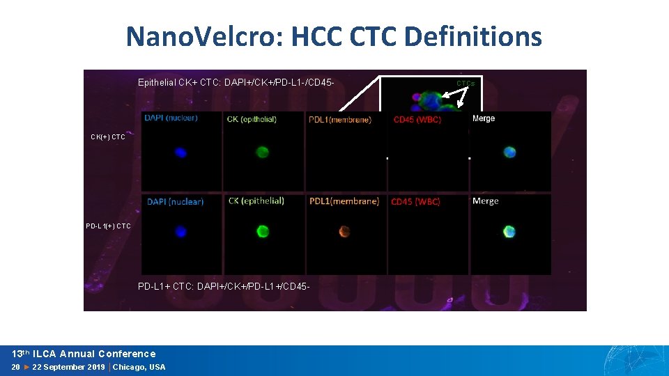 Nano. Velcro: HCC CTC Definitions Epithelial CK+ CTC: DAPI+/CK+/PD-L 1 -/CD 45 - CTCs