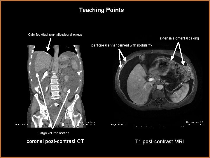 Teaching Points Calcified diaphragmatic pleural plaque extensive omental caking peritoneal enhancement with nodularity Large