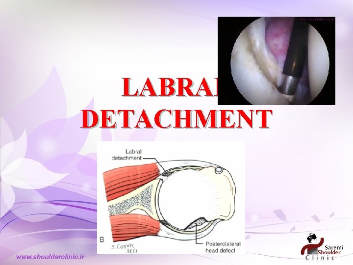 LABRAL DETACHMENT LABRAL DETACHMENT