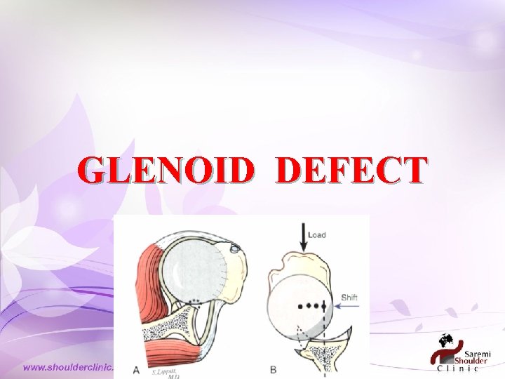 GLENOID DEFECT GLENOID DEFECT