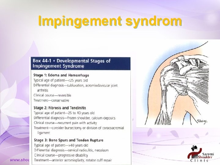 Impingement syndrom Impingement syndrom