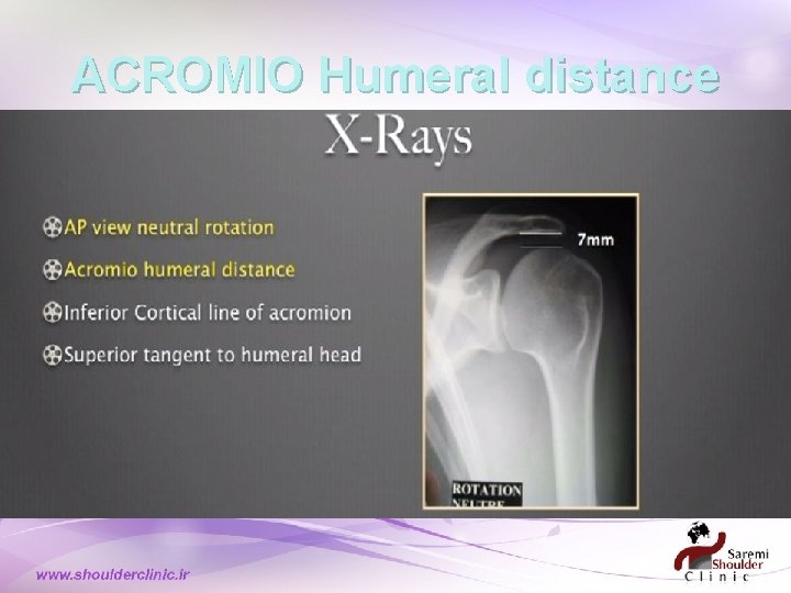 ACROMIO Humeral distance ACROMIO Humeral distance