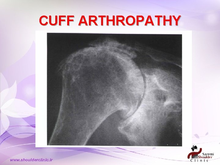 CUFF ARTHROPATHY CUFF ARTHROPATHY