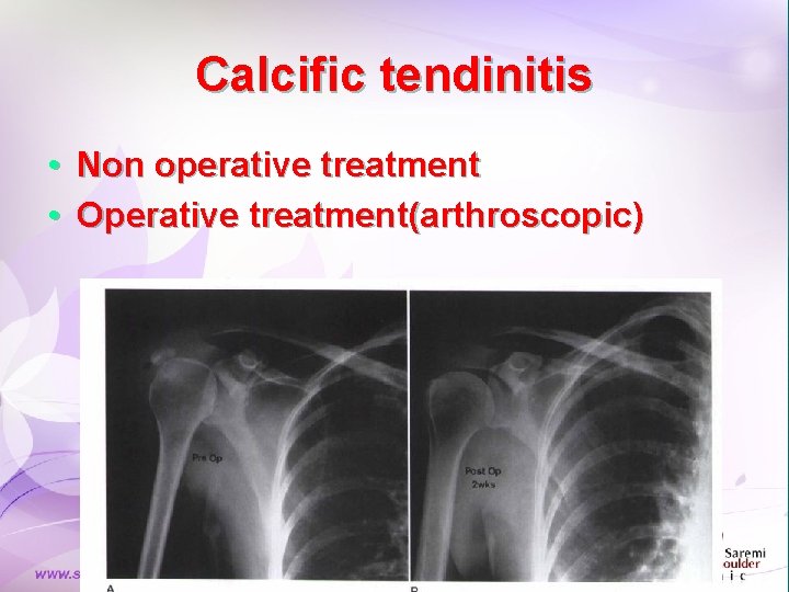 Calcific tendinitis • Non operative treatment • Operative treatment(arthroscopic) Calcific tendinitis • Non operative treatment • Operative treatment(arthroscopic)