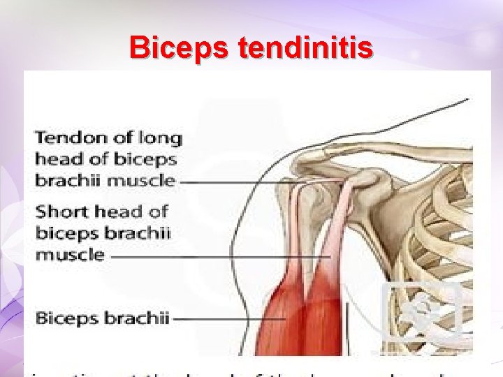 Biceps tendinitis Biceps tendinitis