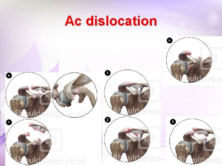 Ac dislocation Ac dislocation