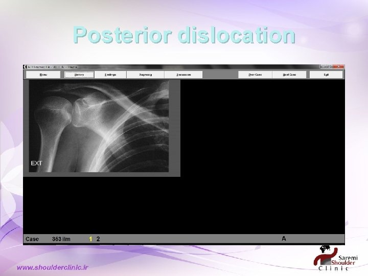 Posterior dislocation Posterior dislocation