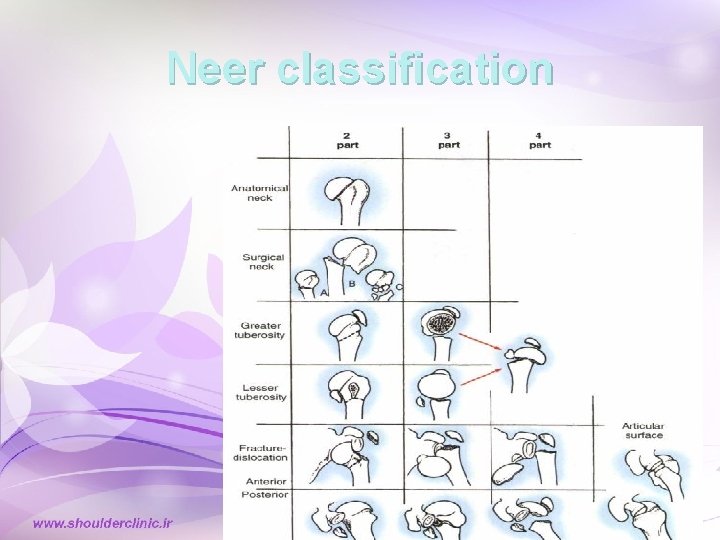 Neer classification Neer classification