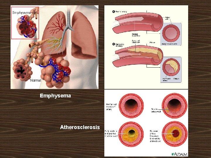 Emphysema Atherosclerosis 
