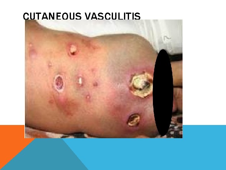 CUTANEOUS VASCULITIS 