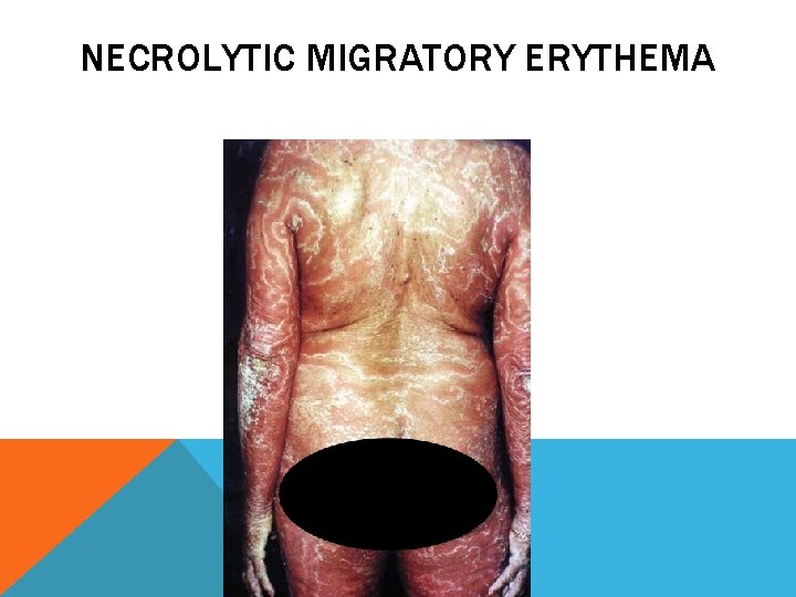 NECROLYTIC MIGRATORY ERYTHEMA 