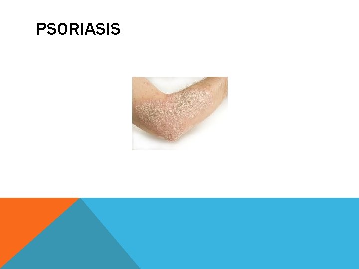 PSORIASIS 