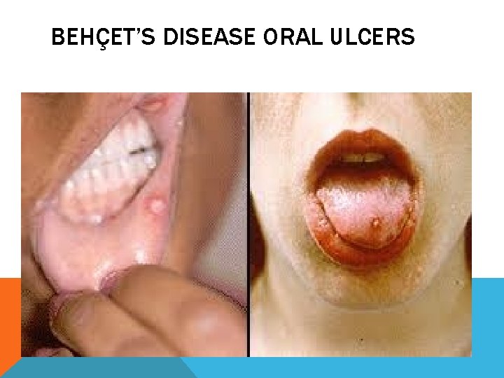 BEHÇET’S DISEASE ORAL ULCERS 