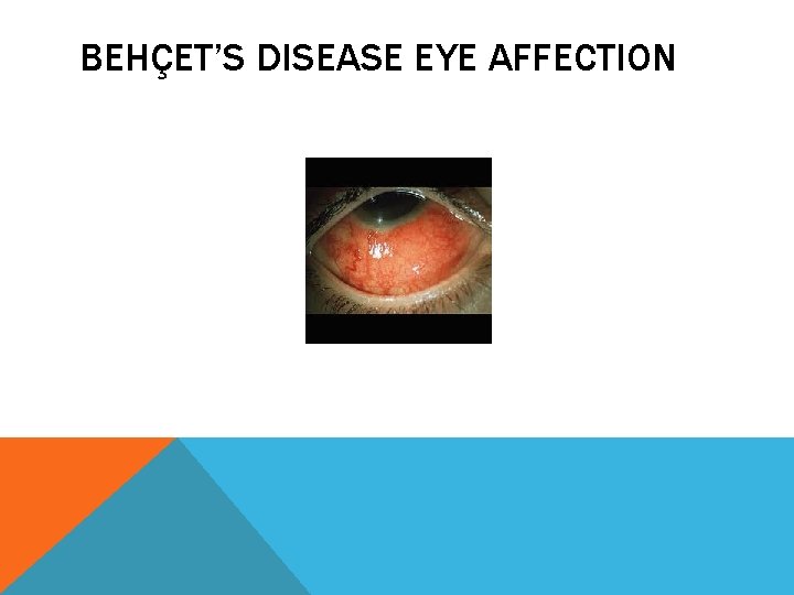 BEHÇET’S DISEASE EYE AFFECTION 