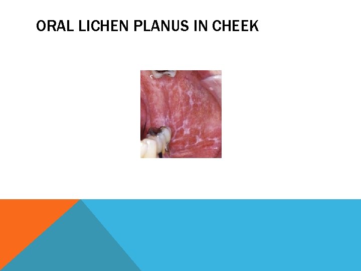 ORAL LICHEN PLANUS IN CHEEK 