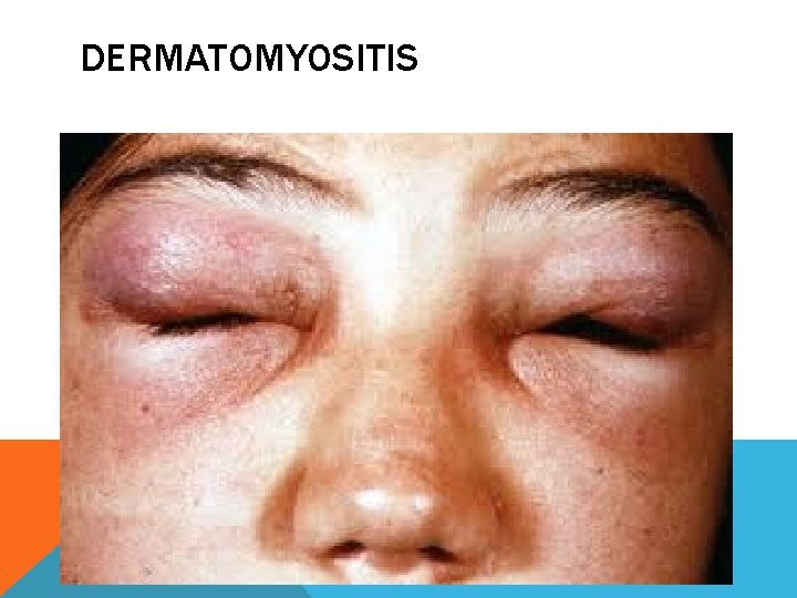 DERMATOMYOSITIS 