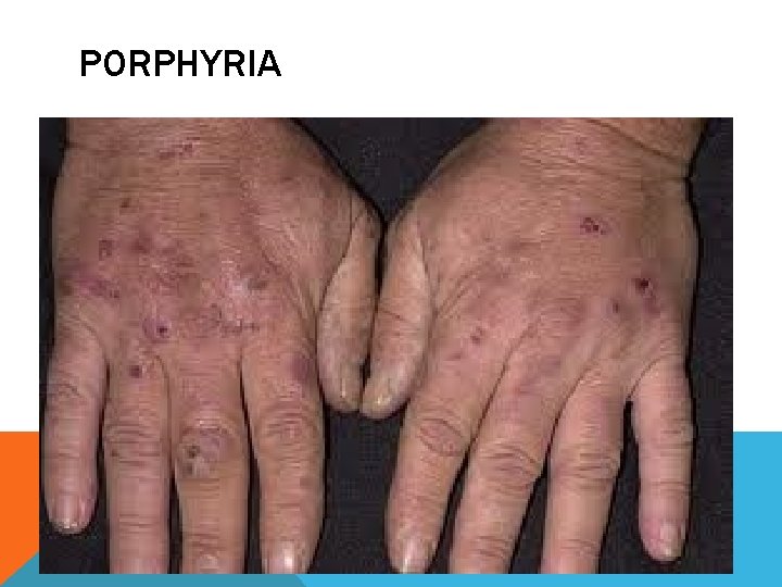 PORPHYRIA 