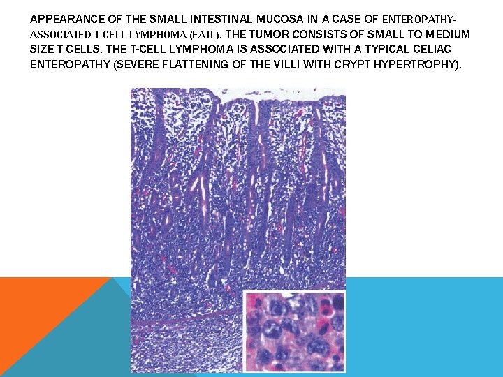 APPEARANCE OF THE SMALL INTESTINAL MUCOSA IN A CASE OF ENTEROPATHYASSOCIATED T-CELL LYMPHOMA (EATL).