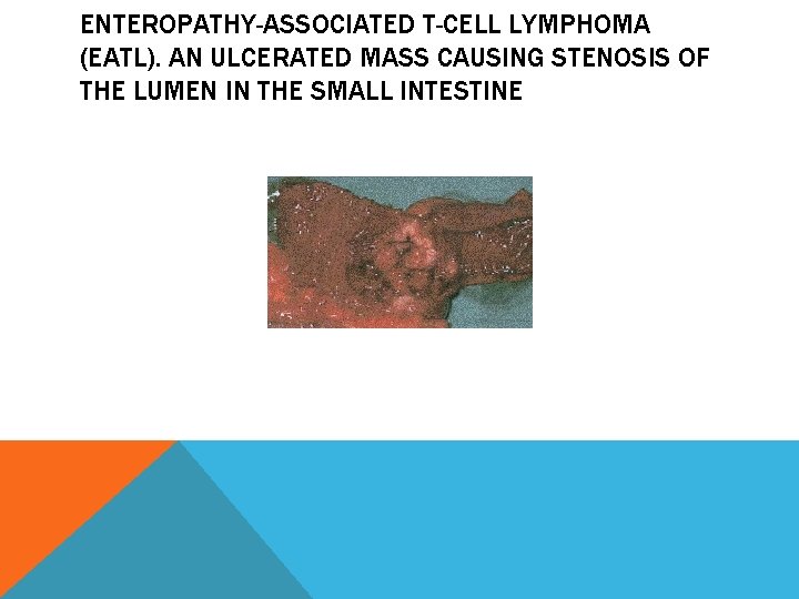 ENTEROPATHY-ASSOCIATED T-CELL LYMPHOMA (EATL). AN ULCERATED MASS CAUSING STENOSIS OF THE LUMEN IN THE