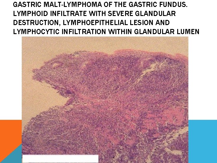 GASTRIC MALT-LYMPHOMA OF THE GASTRIC FUNDUS. LYMPHOID INFILTRATE WITH SEVERE GLANDULAR DESTRUCTION, LYMPHOEPITHELIAL LESION