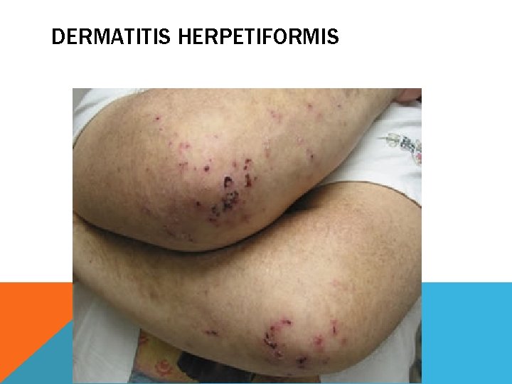 DERMATITIS HERPETIFORMIS 