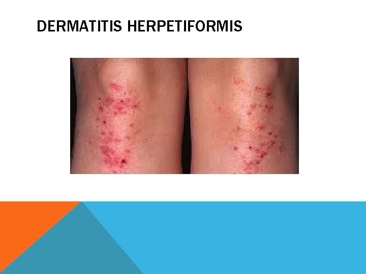 DERMATITIS HERPETIFORMIS 