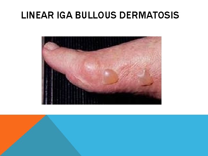 LINEAR IGA BULLOUS DERMATOSIS 