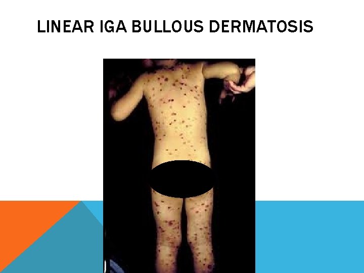 LINEAR IGA BULLOUS DERMATOSIS 