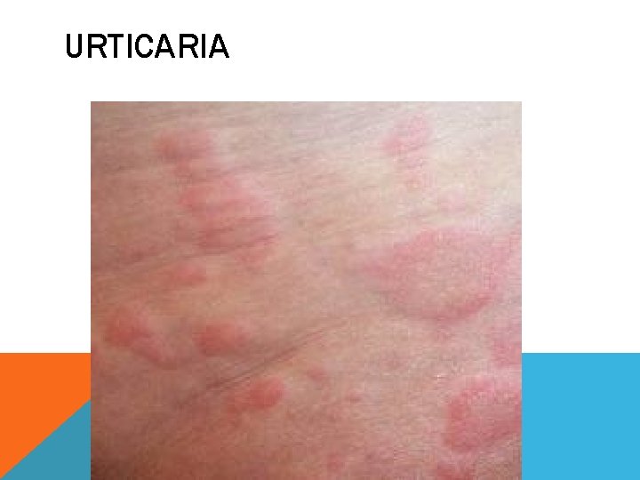 URTICARIA 