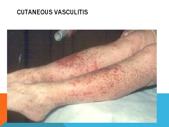 CUTANEOUS VASCULITIS 